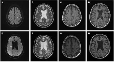 Arteriolosclerosis CSVD: a common cause of dementia and stroke and its association with cognitive function and total MRI burden